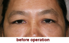 plastic-surgery-blepharoplasty